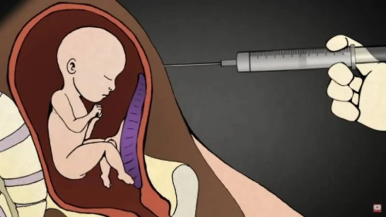 Wird auch in der Schweiz praktiziert: Töten des Babys im Mutterleib mit einer Spritze, bevor dann die Frau ihr totes Kind gebärt. 